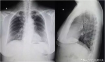 体检胸片没看到什么，CT却发现肺癌